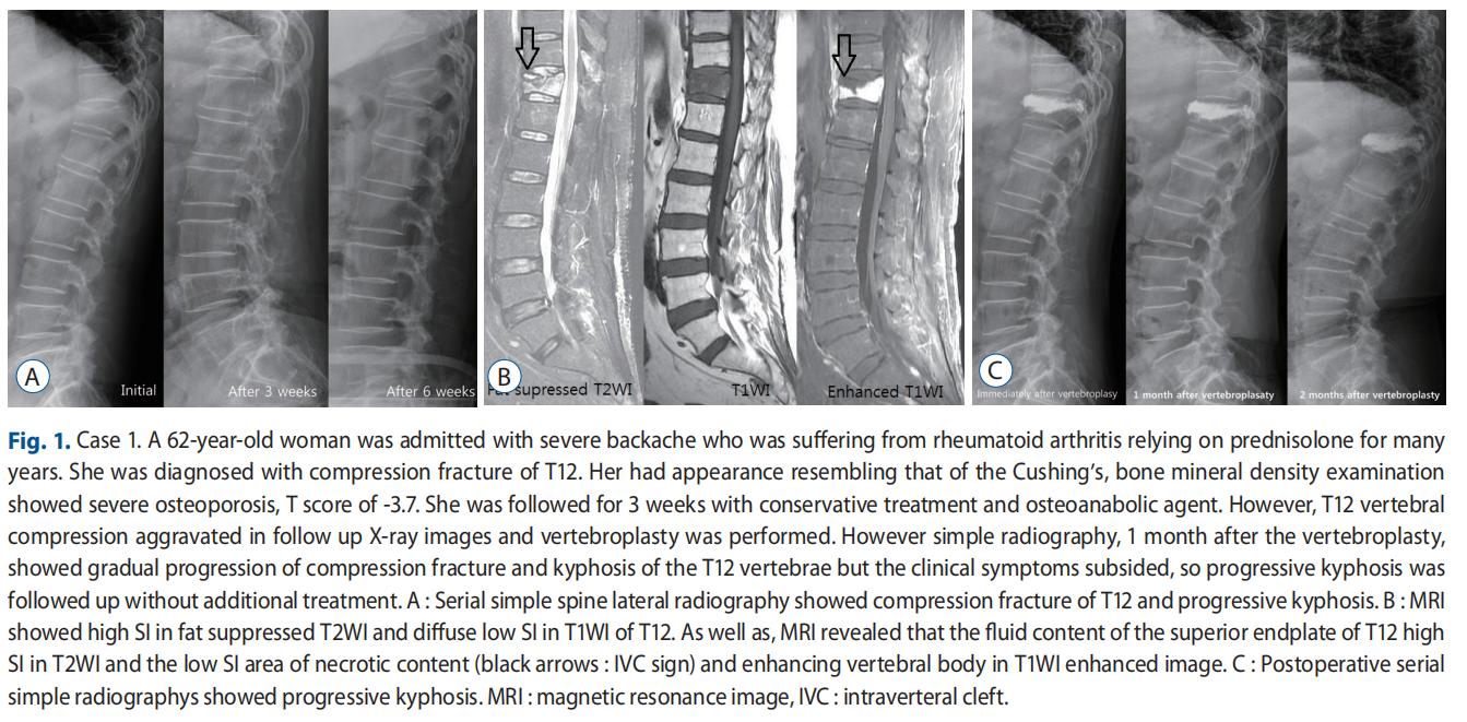 创伤后的右侧颞叶脑出血多久可好,创伤后综合征能恢复吗