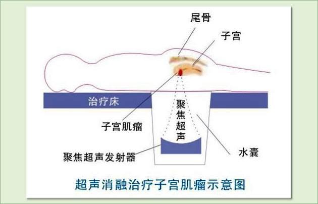 海扶刀是什么病的手术,海扶刀治疗哪些疾病
