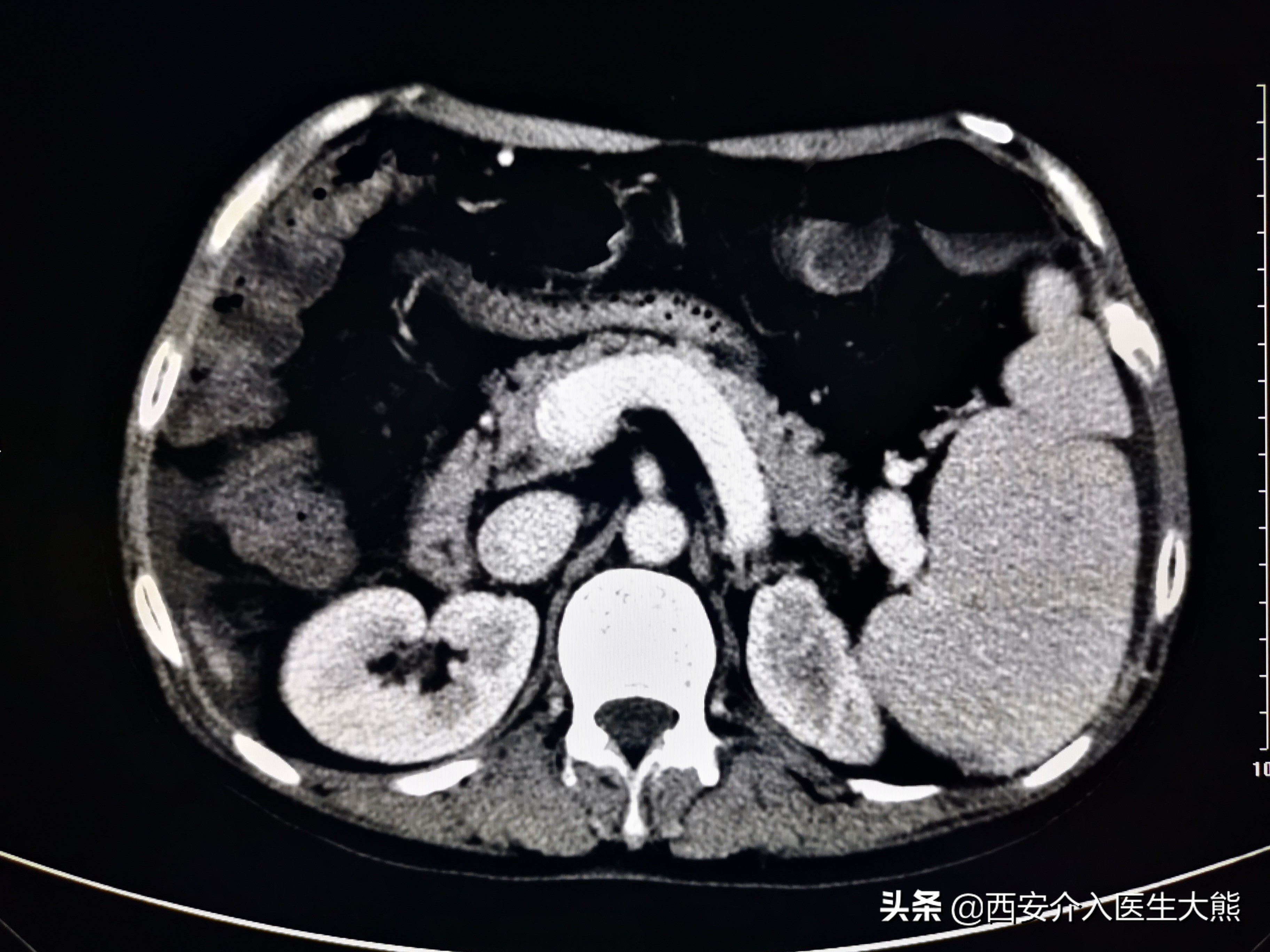 肝硬化消化道出血的病例护理讨论,肝硬化引起的消化道出血如何治疗