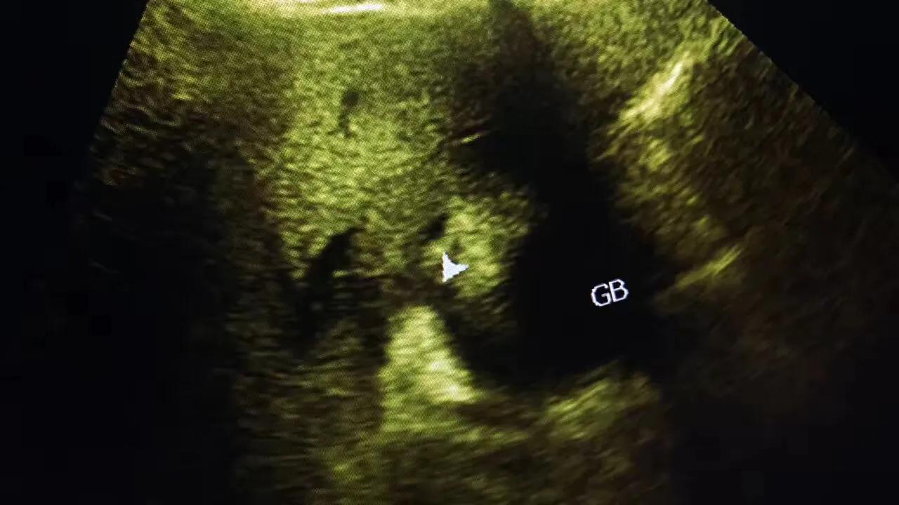 一公分胆结石并且引发急性胆囊炎,一颗胆结石必须摘胆吗