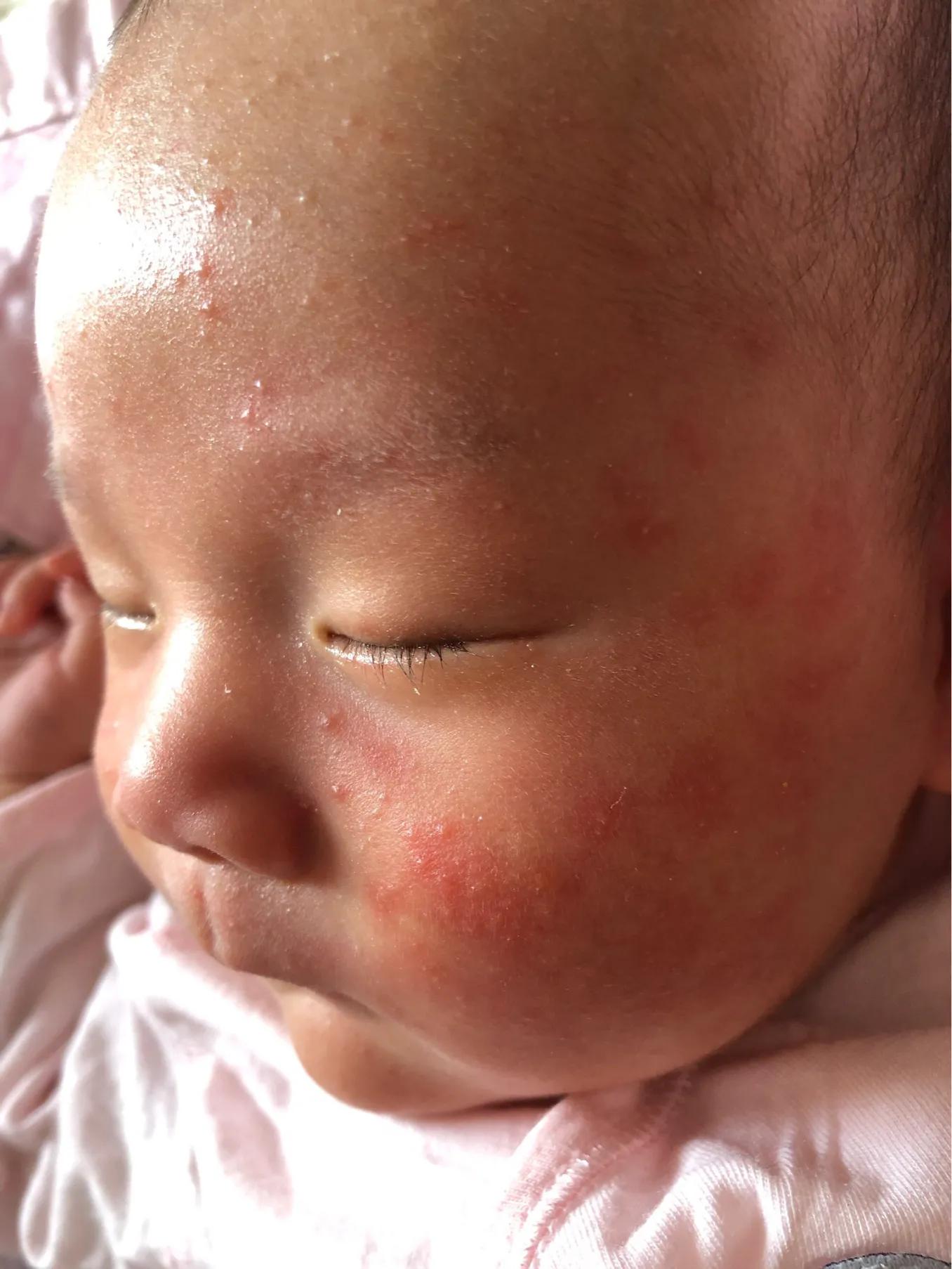 宝宝长湿疹怎么快速消除小妙招,宝宝长湿疹怎么快速消除小窍门