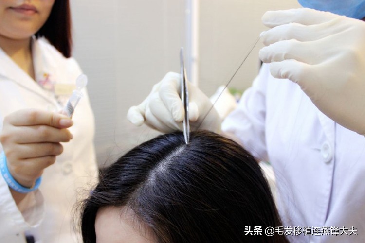 米诺地尔治疗男性脱发有效果吗,米诺地尔治疗脱发