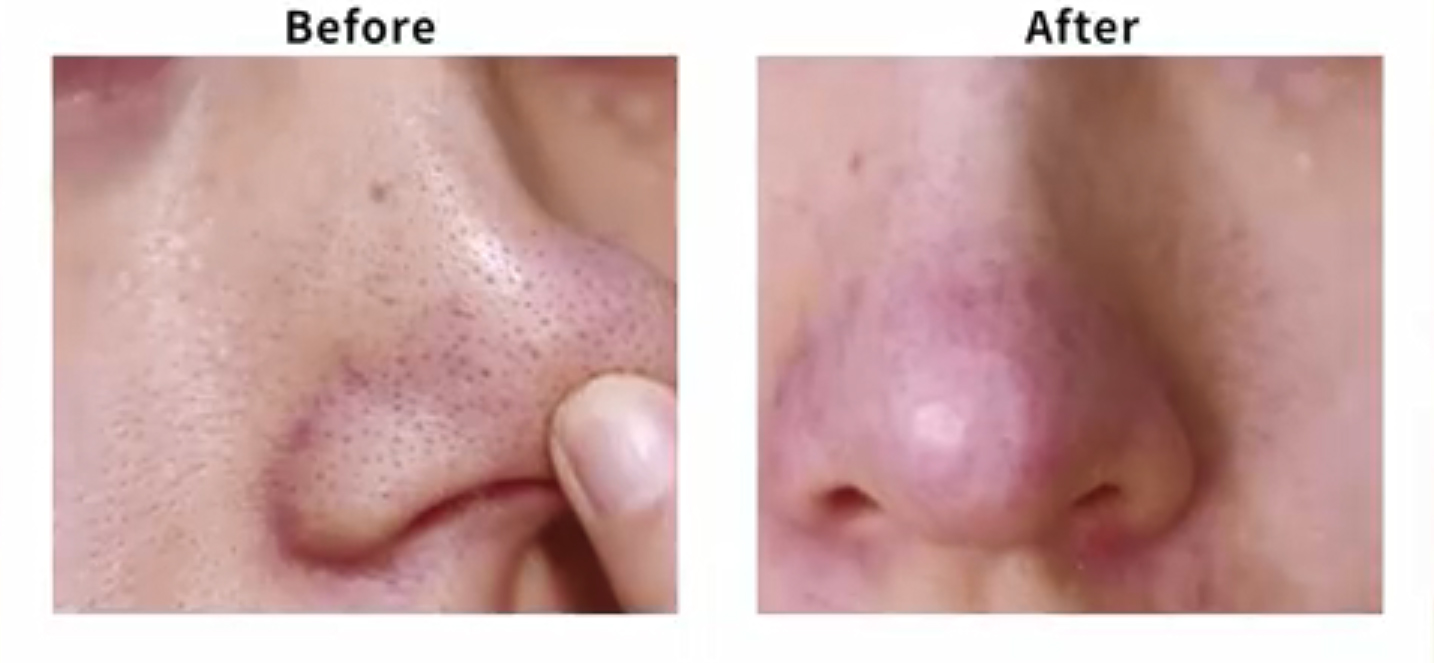 黑头多怎么办干货,黑头闭口挤完怎么处理