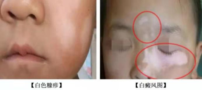 白斑是白癜风还是糠疹如何鉴别呢,宝宝脸上有白斑是脾胃虚吗