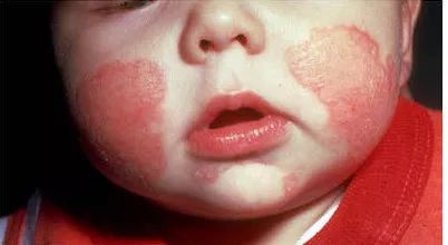 小孩湿疹老是不好怎么办,孩子湿疹怎么办最有效的方法