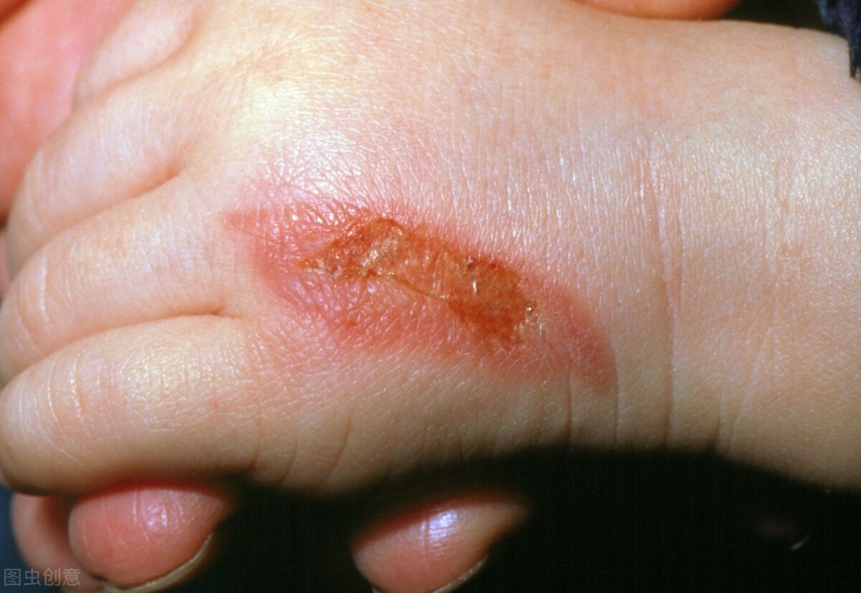 预防儿童烫伤的十大关注事项,对儿童烫伤的急救原则