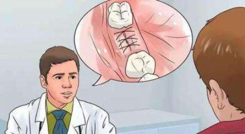 拔完牙神经多长时间恢复正常,拔完牙张口受限多少天能恢复