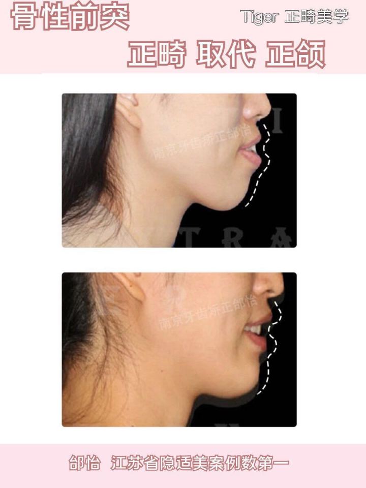 隐适美矫正网上为什么这么便宜,隐适美矫正会不会比预期的快