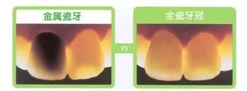 钴铬合金烤瓷牙牙龈变黑怎么处理,烤瓷牙崩瓷了怎么修复