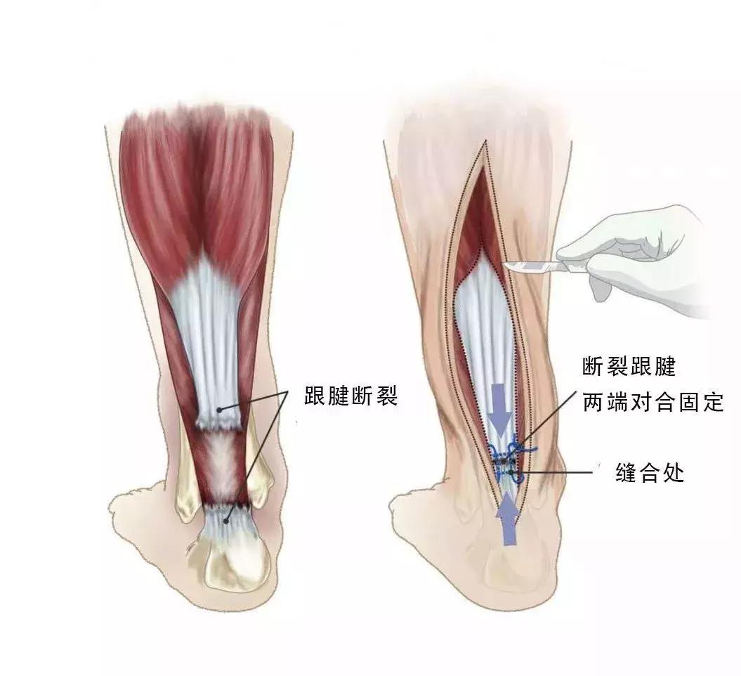 跟腱断裂原因分析,跟腱断裂发病机制