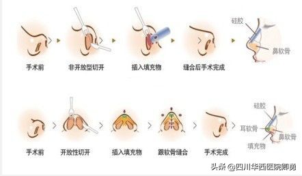 鼻部整形所有的项目,鼻部修复手术恢复