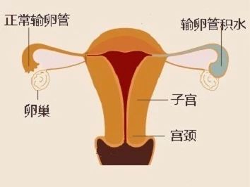 女孩一侧输卵管被切除,23岁女孩输卵管被切除