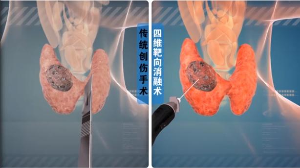 甲状腺结节患者真实案例视频,查出甲状腺结节6年没复查了