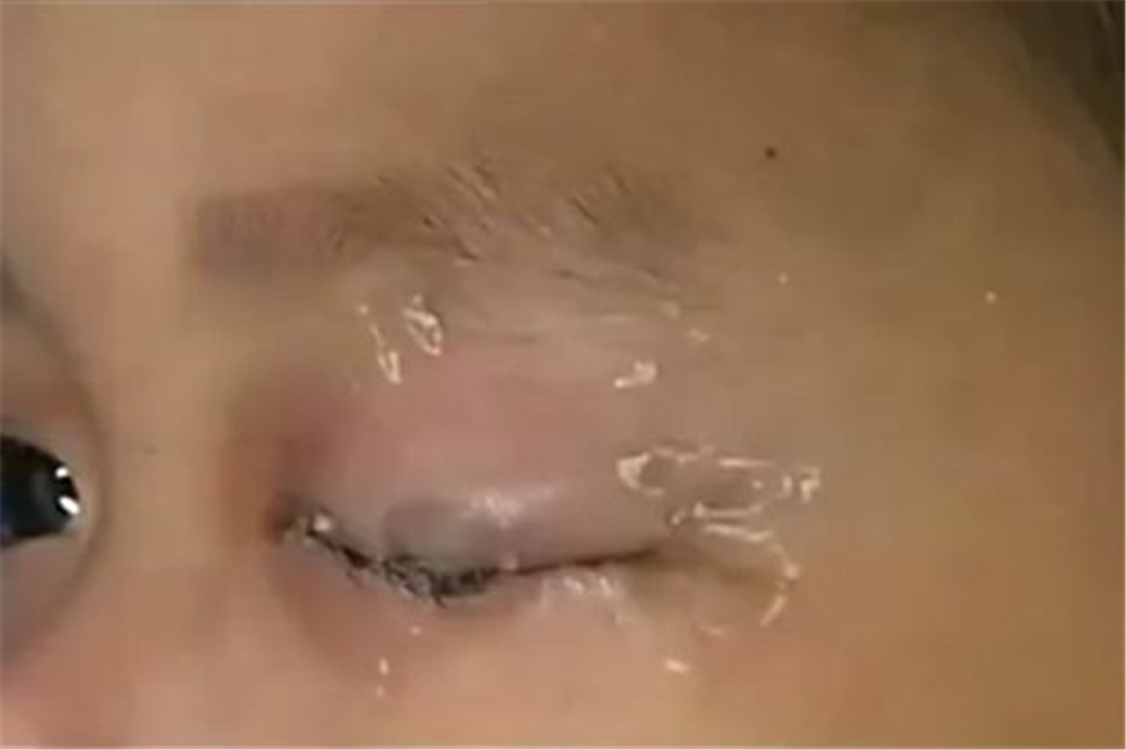 危险502误当眼药水福州6岁男孩,3岁儿童误将502滴入眼