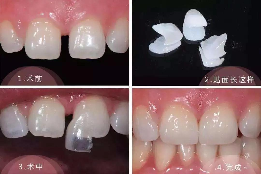 瓷贴面微笑的力量,局部瓷贴面