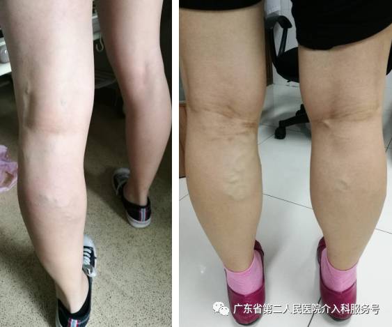 机器引导打针，精准治疗产后静脉曲张