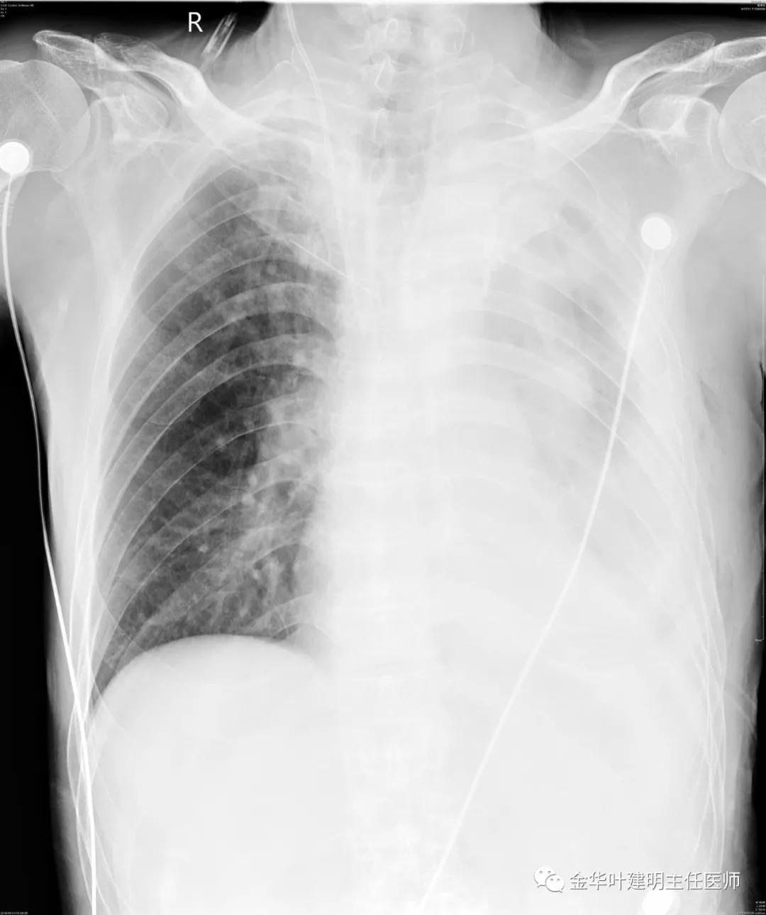 肺手术后乳糜胸是医疗事故吗,肺部切除后乳糜胸治好了