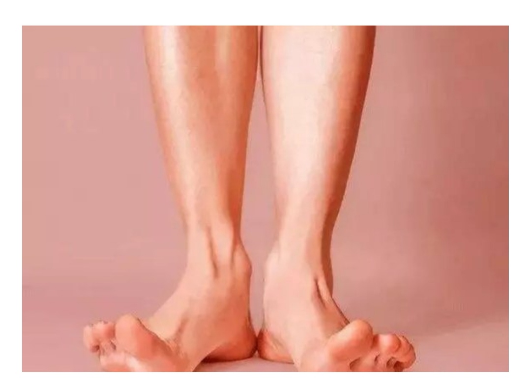 扁平足治疗手术费用,扁平足儿童专用鞋