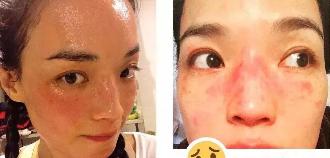 皮肤化妆品过敏最快缓解方法,皮肤过敏一定是化妆品的错吗