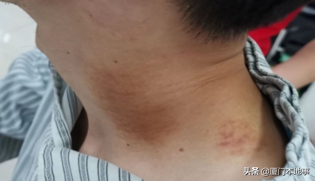 家门口按摩刮痧后，36岁男子脑梗！这个部位真的不能随便按