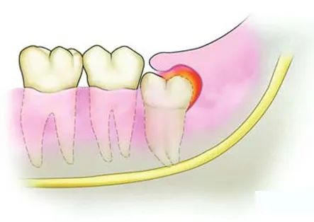 疫情期间无法看牙,疫情期间没看好的牙怎么办