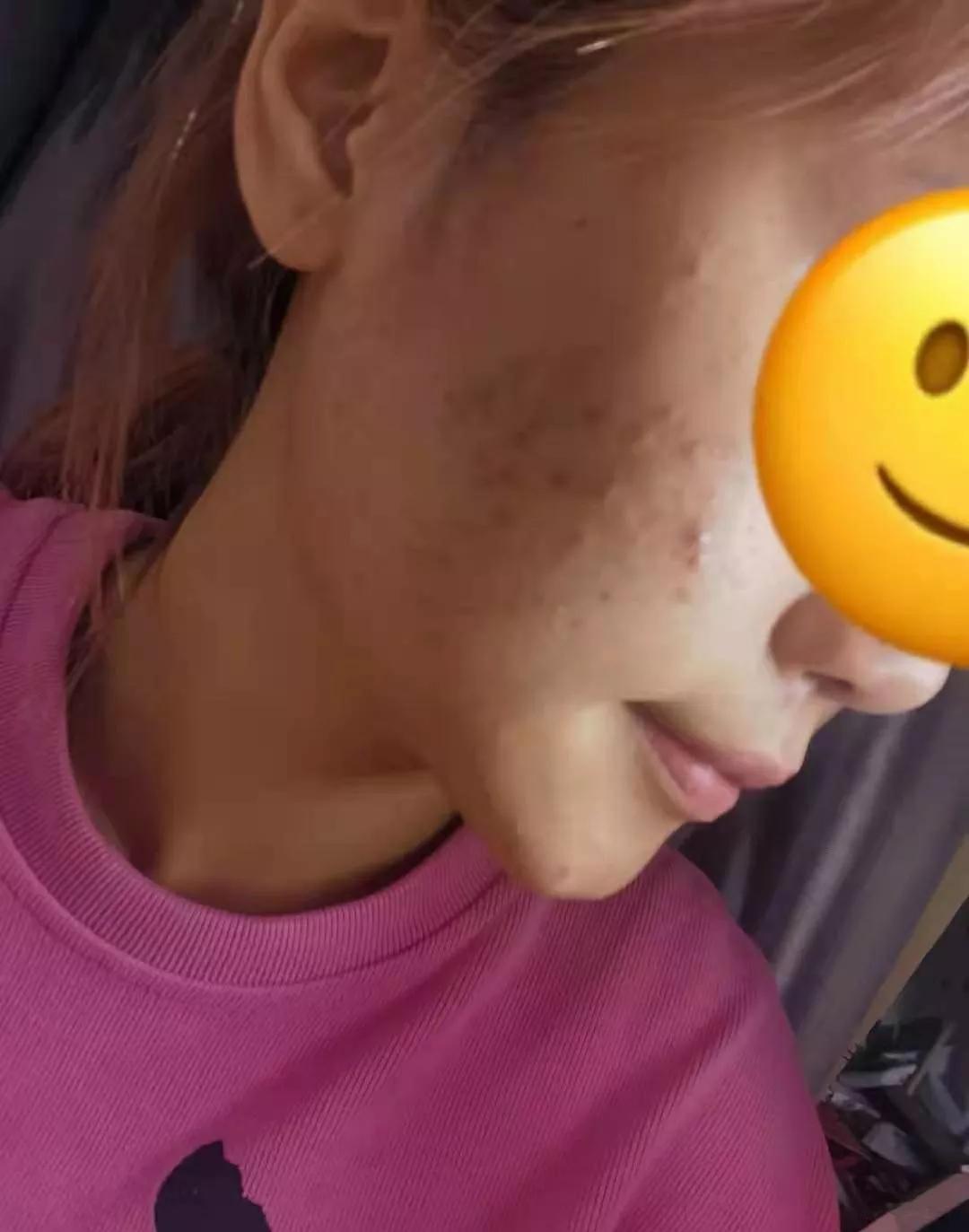 北京看痘痘好的皮肤科医院,去皮肤科看痘痘好不好