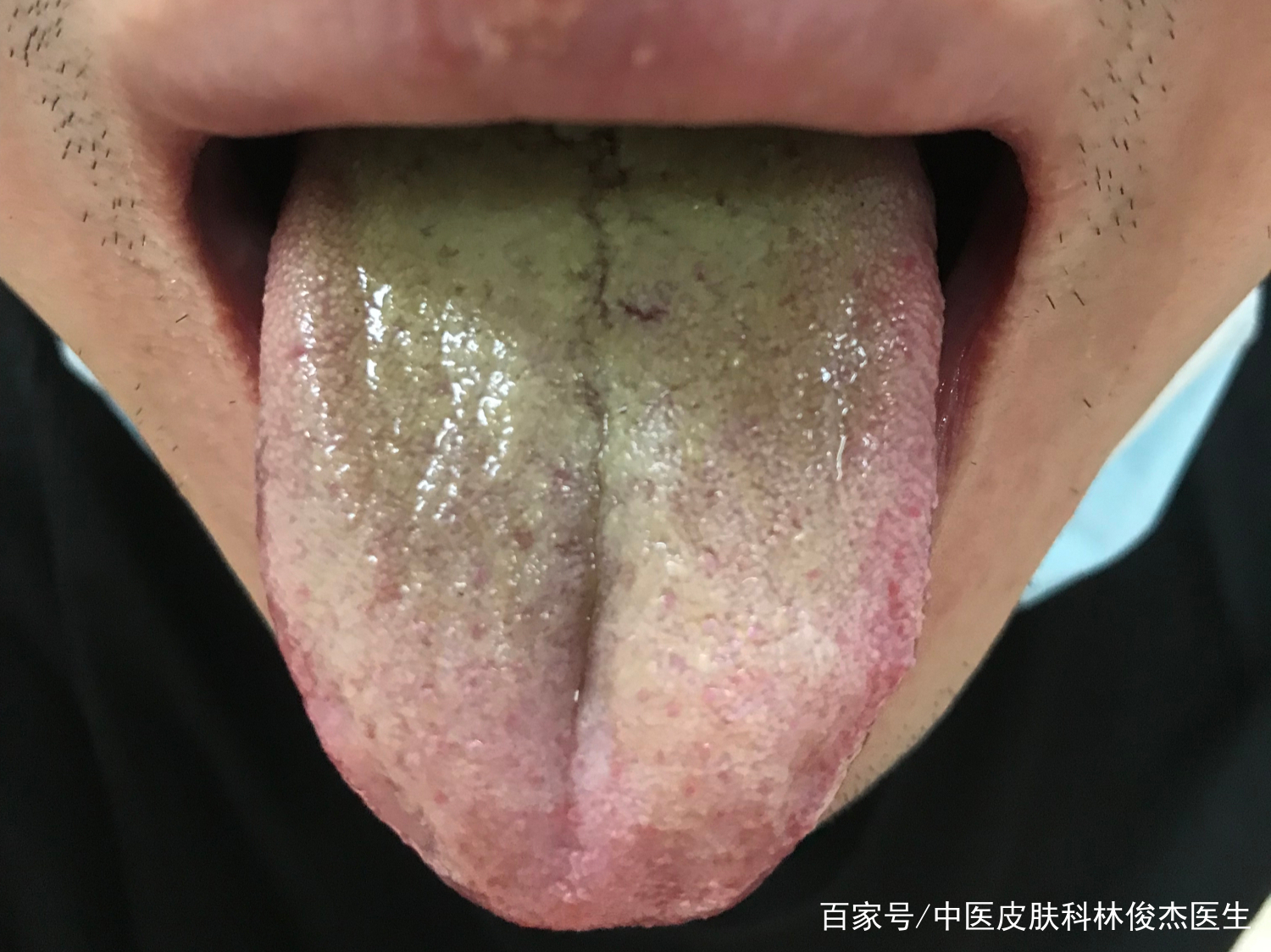 脸上长火疖子大便干结口干舌燥,脸上出油痤疮大便稀是什么湿热