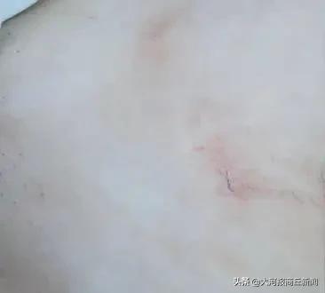 25岁女孩肚子巨型肿瘤,肚子里特大肿瘤的25岁女孩