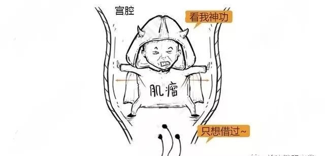 子宫肌瘤动漫演示,子宫肌瘤是什么原因导致的漫画