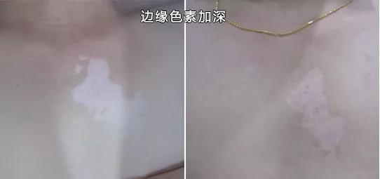 308光疗治疗白癜风副作用,308白癜风光疗后掉皮正常吗