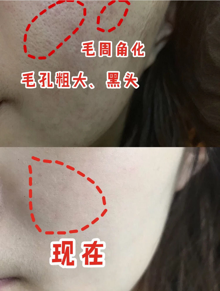 维生素b6加什么去黑头缩毛孔,头发出油厉害吃维生素b6有用吗