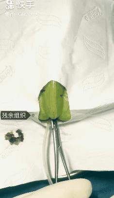 香蕉割包皮，洋葱剖腹产？这是我见过最秀的医生