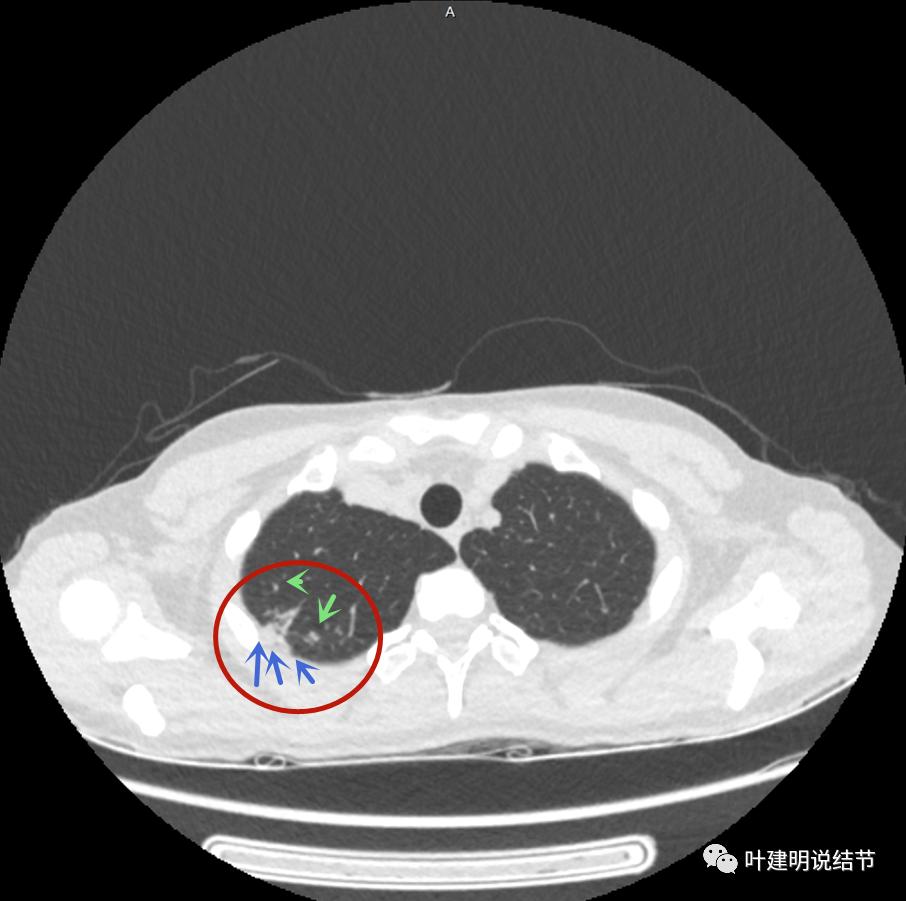 临床诊断孤立性肺结节,空洞型结节一般是什么性质