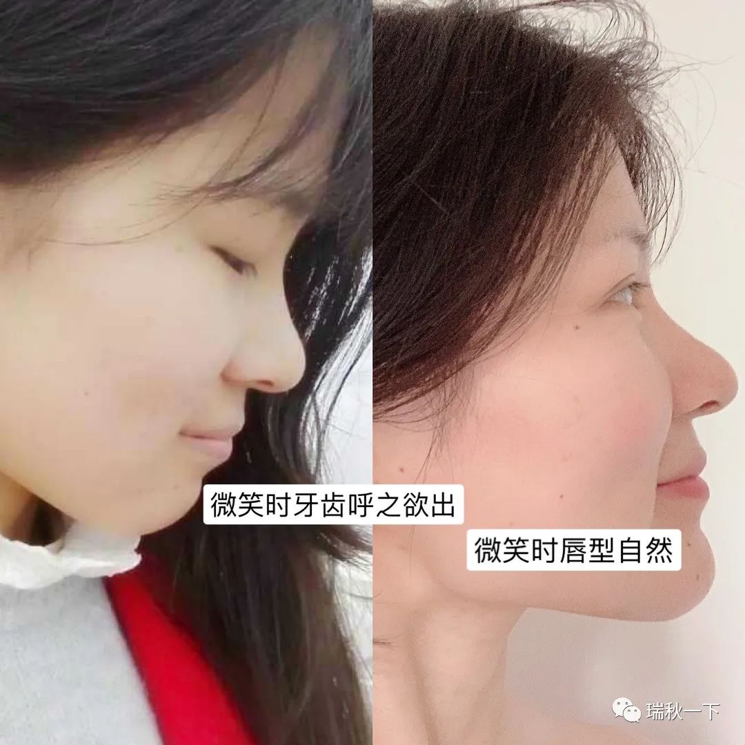 牙齿矫正，你后悔了吗？