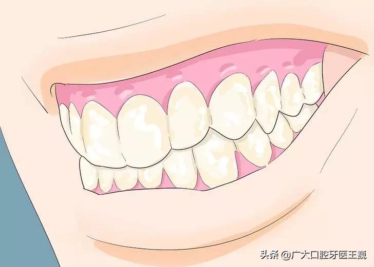 烤瓷牙里面的牙齿腐烂视频,牙齿从牙根开始腐烂怎么办