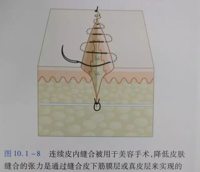 刀口闭合需要多久,伤口闭合除了缝针还有什么方法