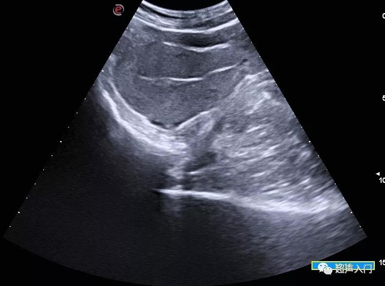 超声如何判断子宫位置,超声上怎么判断子宫后位
