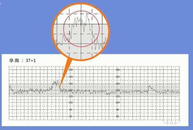 胎心监护时胎心率怎么断断续续的,胎心如何找