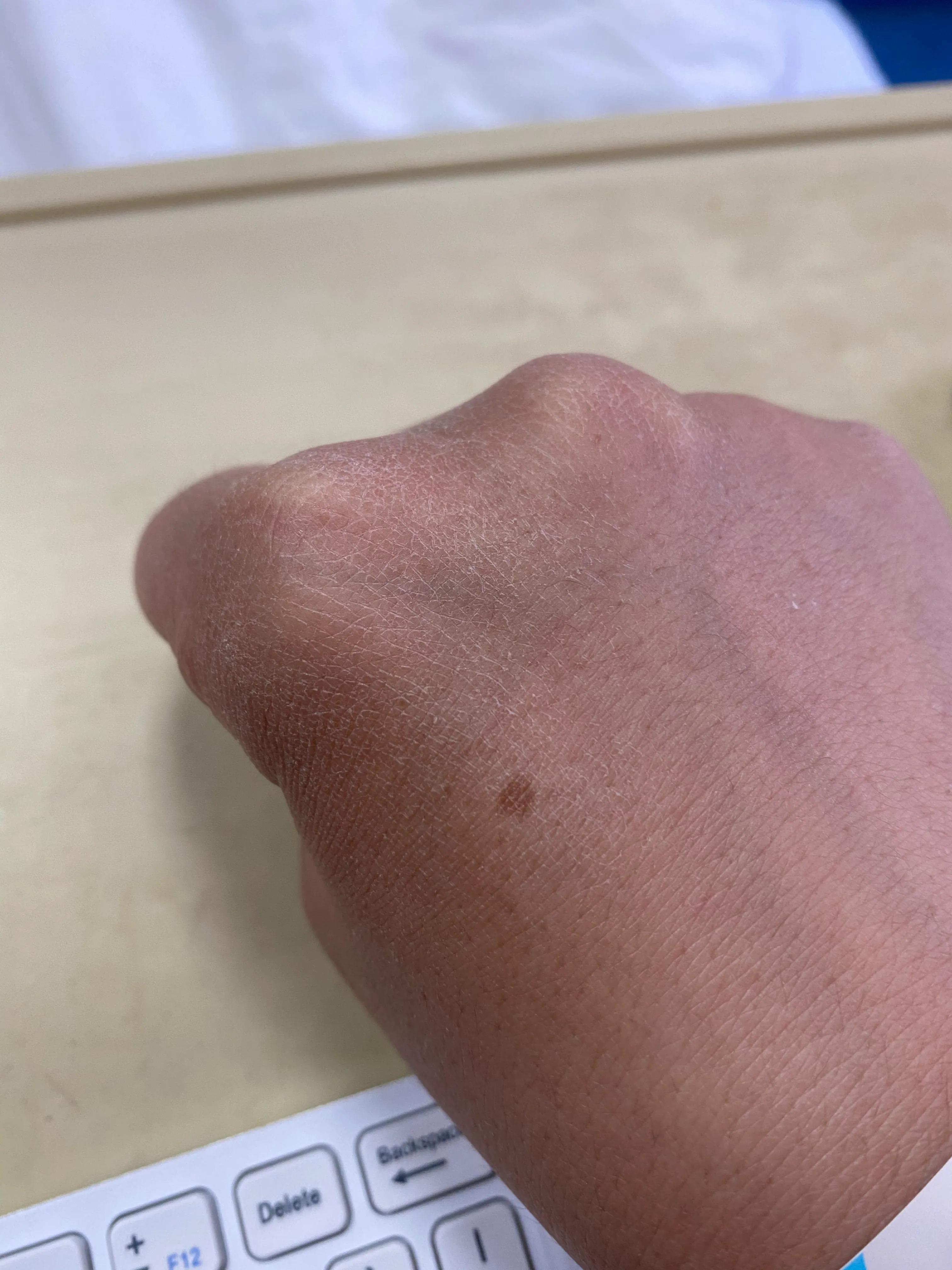 白血病患者正在化疗第六天,白血病第5次化疗什么样