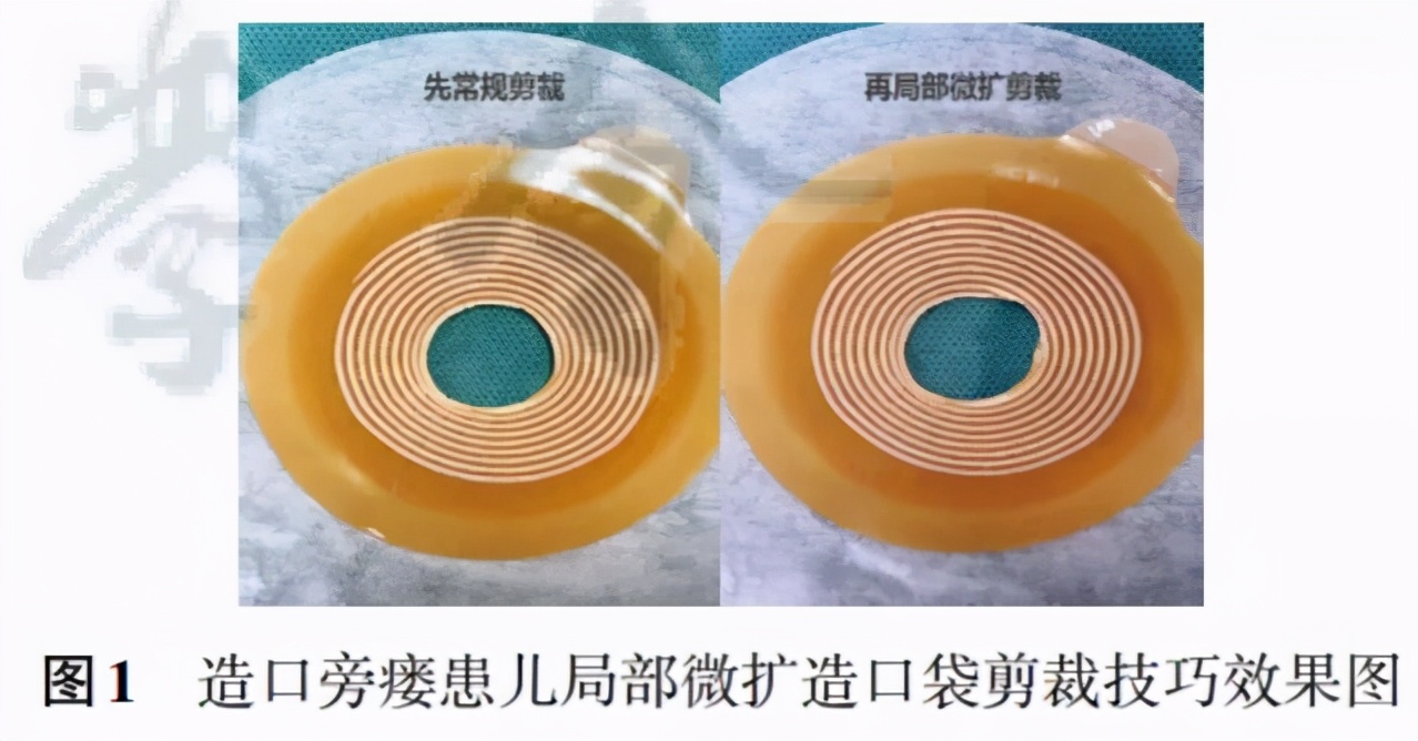 肠造口护理查房ppt,成人肠造口护理标准