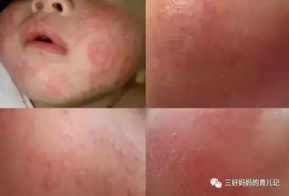 夏天出幼儿急疹怎么和痱子区分,如何判断宝宝是痱子还是幼儿急疹