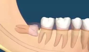 俞灏明牙龈上火原因,俞灏明牙龈上火了吗