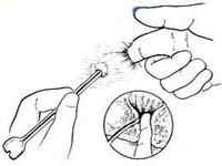 高位复杂性肛瘘最好的治疗方法,高位复杂性肛瘘不痛不痒不流脓