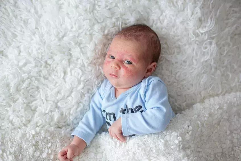 湿疹根除不了吗,湿疹治不了根