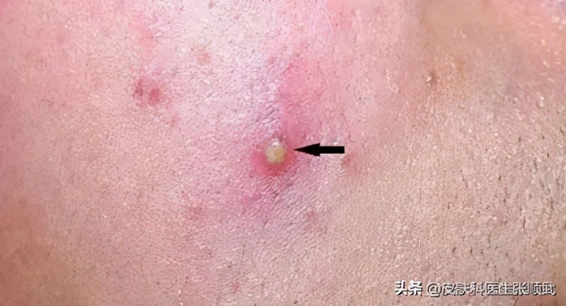 前胸后背长毛囊炎可以自愈吗,背部长毛囊炎怎么消除