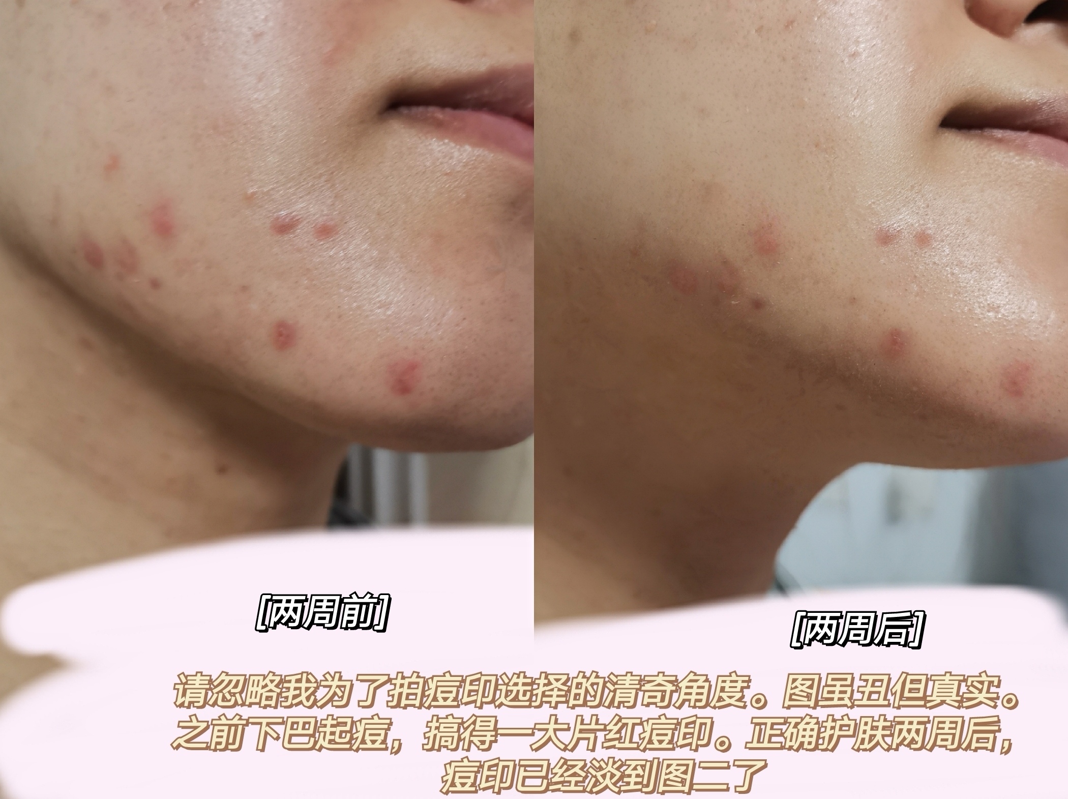 自己祛痘印最好方法快速祛除痘坑,怎么能更有效的祛痘印呢