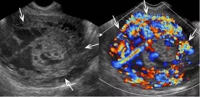 干货分享丨正常胎盘与异常胎盘的超声表现