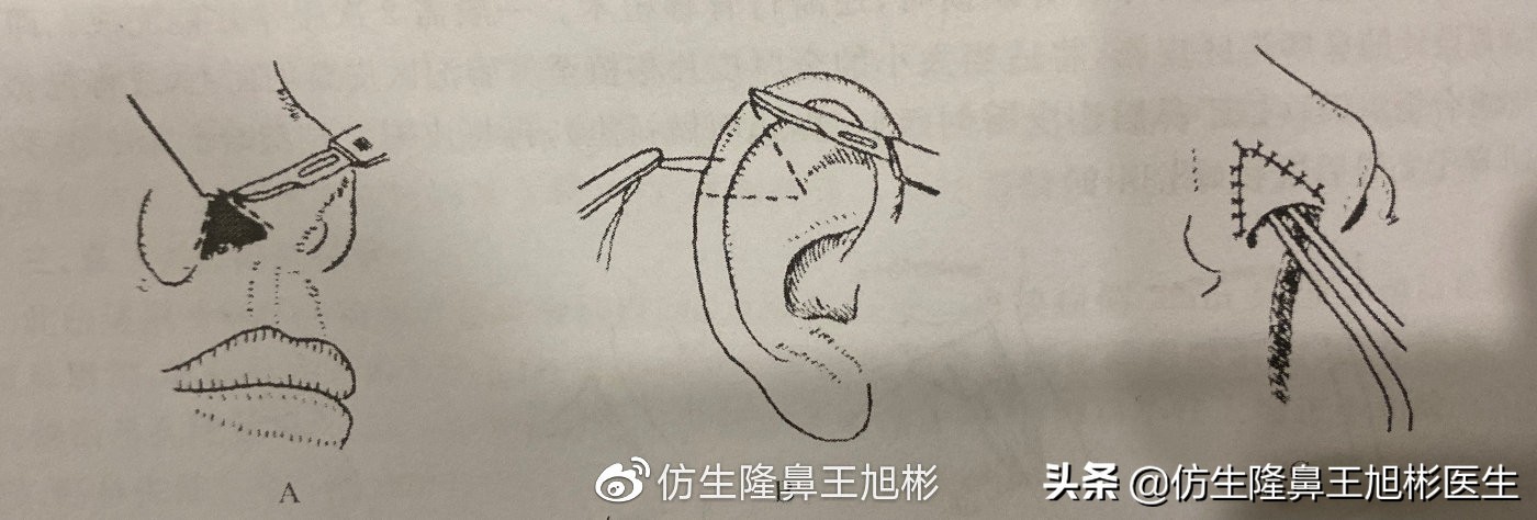 鼻翼缘畏缩要如何矫正|王旭彬隆鼻
