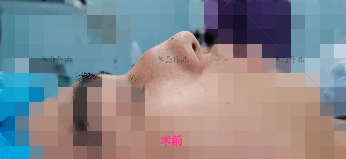 驼峰鼻怎么打鼻影,驼峰鼻用什么材料隆鼻