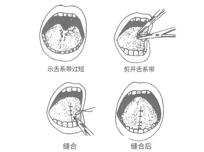 宝宝舌系带短剪了还是说话不清晰,宝宝舌系带过短剪了还是吐不出来